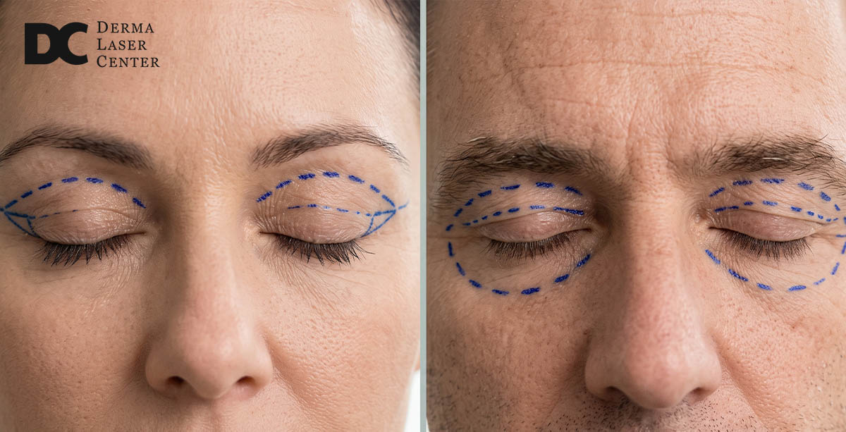 Female vs Male Blepharoplasty