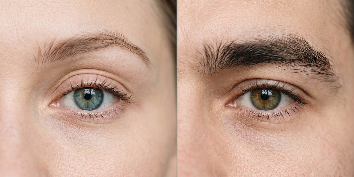 How Eyelid Anatomy and Goals Differ Between Men and Women