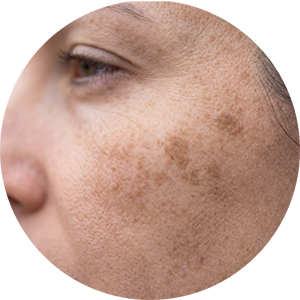 Sun Damage and Age Spots