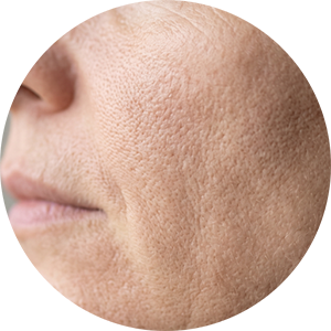 Uneven Skin Texture
