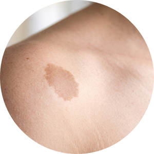 Warts, Birthmarks, and Rhinophyma
