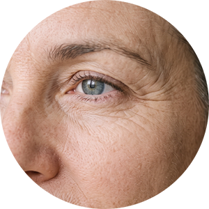 Wrinkles and Fine Lines